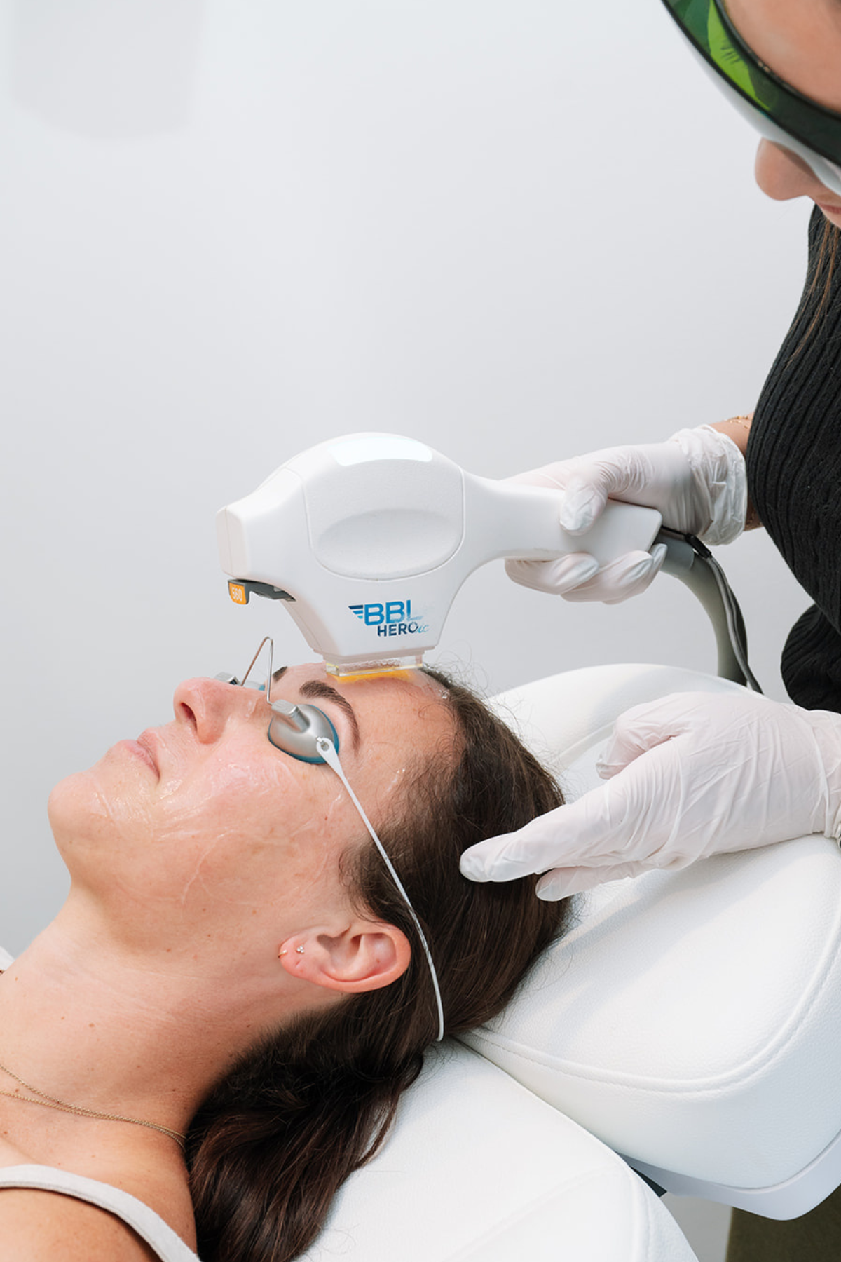 BBL Photofacial: Your New BFF