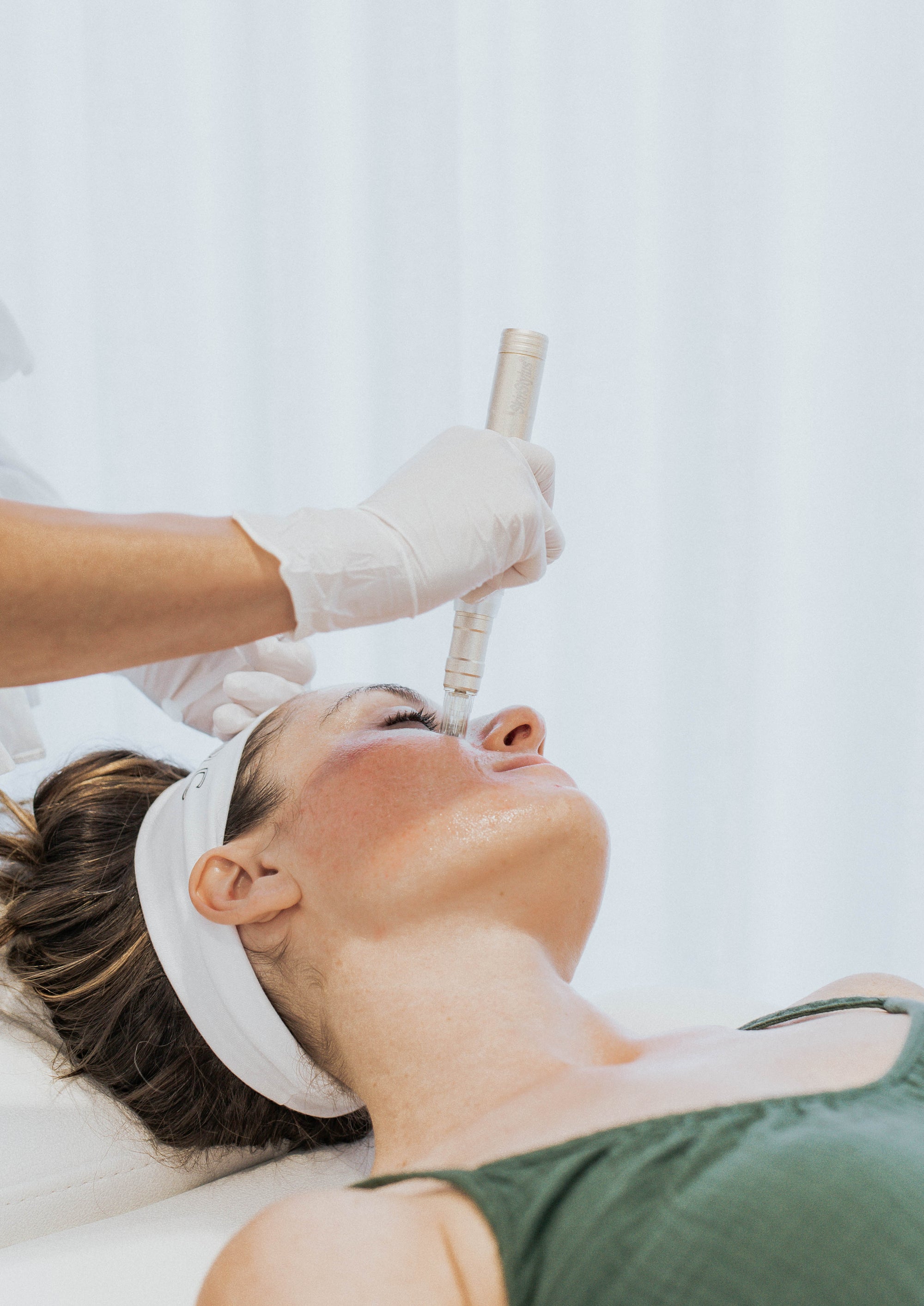 Microneedling for Acne Scars: Does It Really Work?