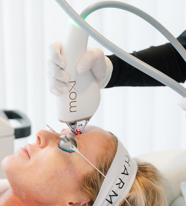 What Is Moxi Laser Treatment & Benefits