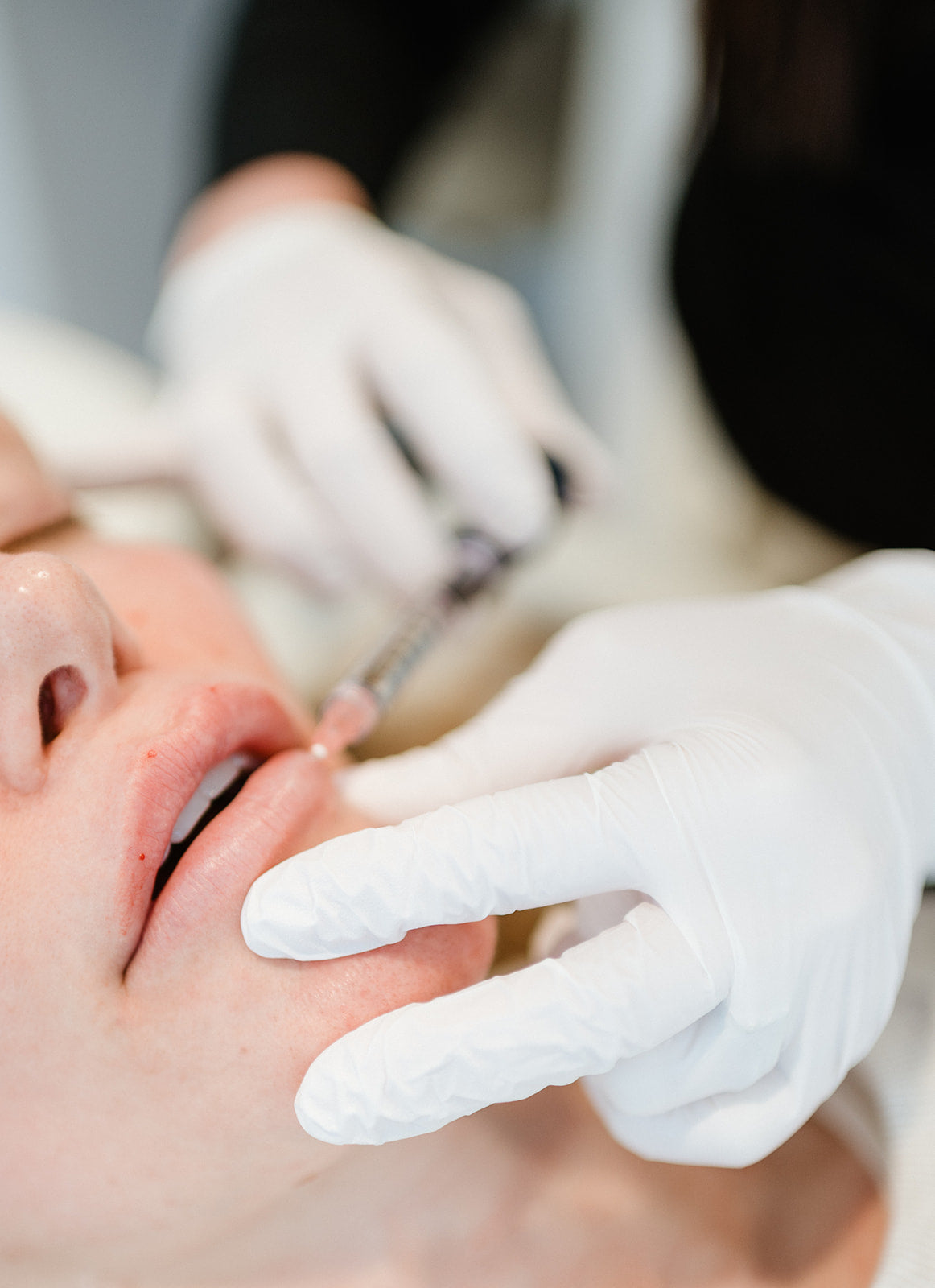 Skin Pharm Does Lip Filler Right